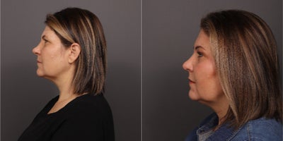 before and after image