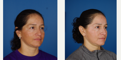 Chemical Peel before and after photo