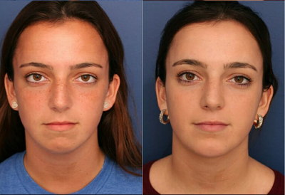 Chin Implant before and after photo