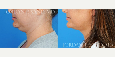 FaceTite before and after photo