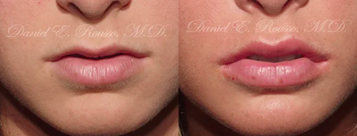 Juvederm before and after photo