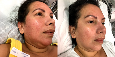 Laser Peel before and after photo
