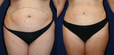 Liposuction before and after photo