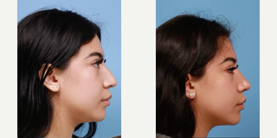 Rhinoplasty before and after photo