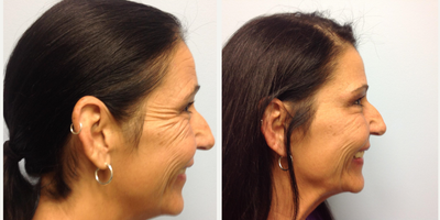 Botox before and after photo