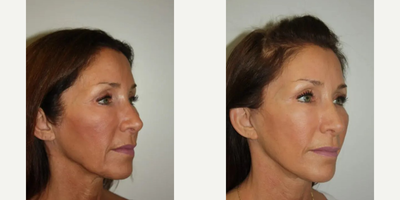 Deep Plane Facelift before and after photo