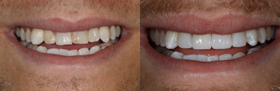 Dental Crown before and after photo