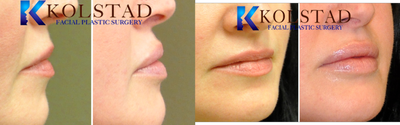 Lip Fillers before and after photo