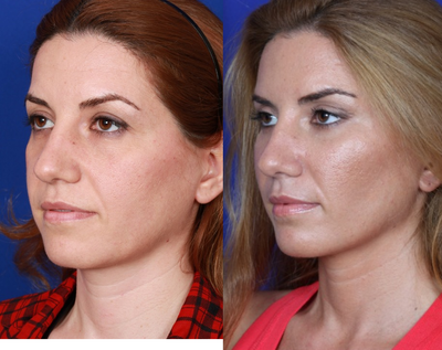 Cheek Lift before and after photo