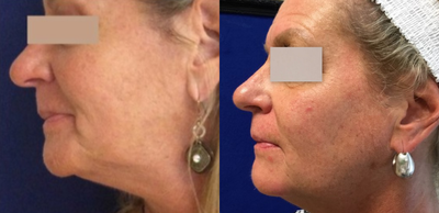 Dermal Fillers before and after photo