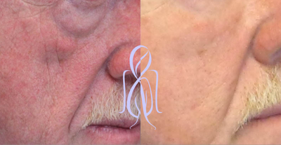 Buccal Fat Removal before and after photo