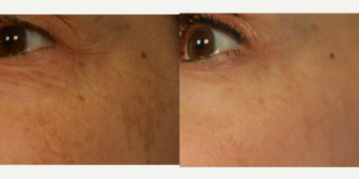 Chemical Peel before and after photo