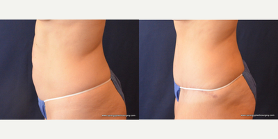 Tummy Tuck before and after photo