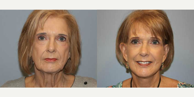 Facelift before and after photo