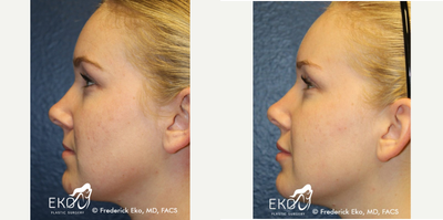 Juvederm before and after photo