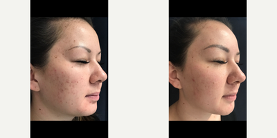 PicoSure before and after photo