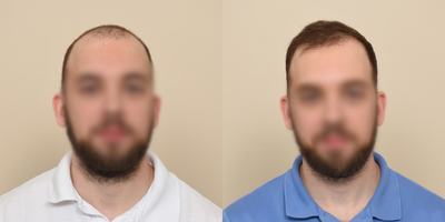 PRP for Hair Loss before and after photo