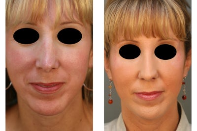 Revision Rhinoplasty before and after photo
