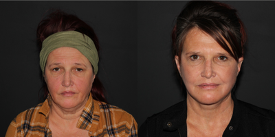 CO2 Laser before and after photo