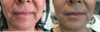 Dermal Fillers before and after photo