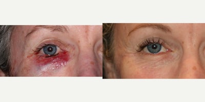 Eyelid Surgery before and after photo