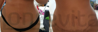 Tummy Tuck before and after photo