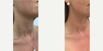 Dermal Fillers before and after photo