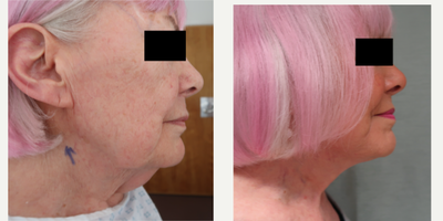 Facelift before and after photo
