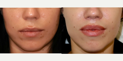 Lip Lift before and after photo