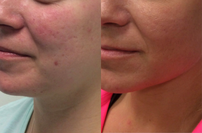 Microneedling before and after photo