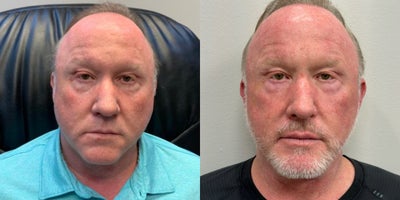 Neck Lift before and after photo