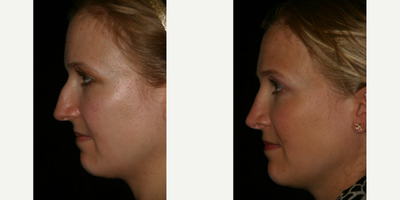 Rhinoplasty before and after photo