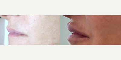 Dermal Fillers before and after photo
