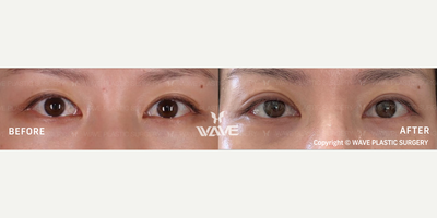 Eyelid Surgery before and after photo