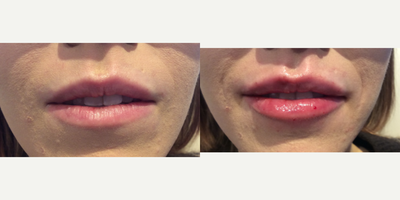 Juvederm before and after photo