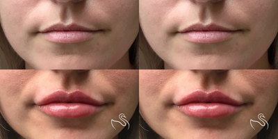 Lip Fillers before and after photo