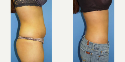 Liposuction before and after photo