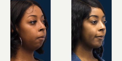 Chin Implant before and after photo
