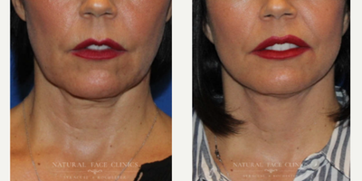 Chin Liposuction before and after photo