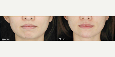 Dermal Fillers before and after photo