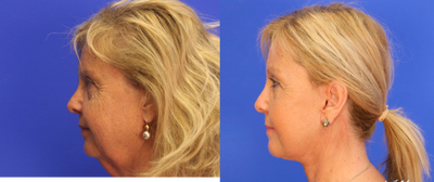Facelift before and after photo