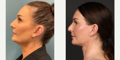 Facelift before and after photo