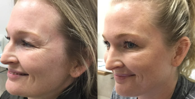 Botox before and after photo