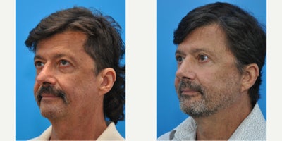 Eyelid Surgery before and after photo