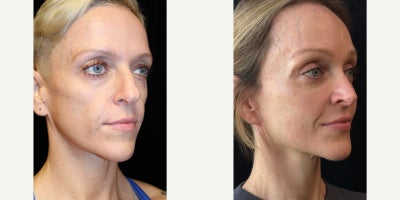Facelift before and after photo