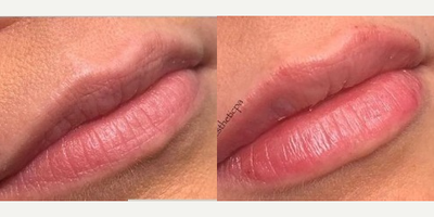 Lip Fillers before and after photo