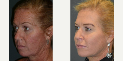 Liquid Facelift before and after photo