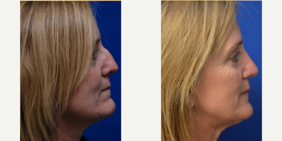 Rhinoplasty before and after photo