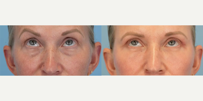 Eyelid Surgery before and after photo