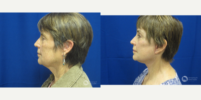 Neck Lift before and after photo